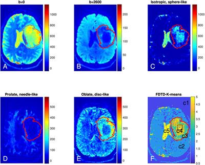 Measurement of Full Diffusion Tensor Distribution Using High-Gradient Diffusion MRI and Applications in Diffuse Gliomas